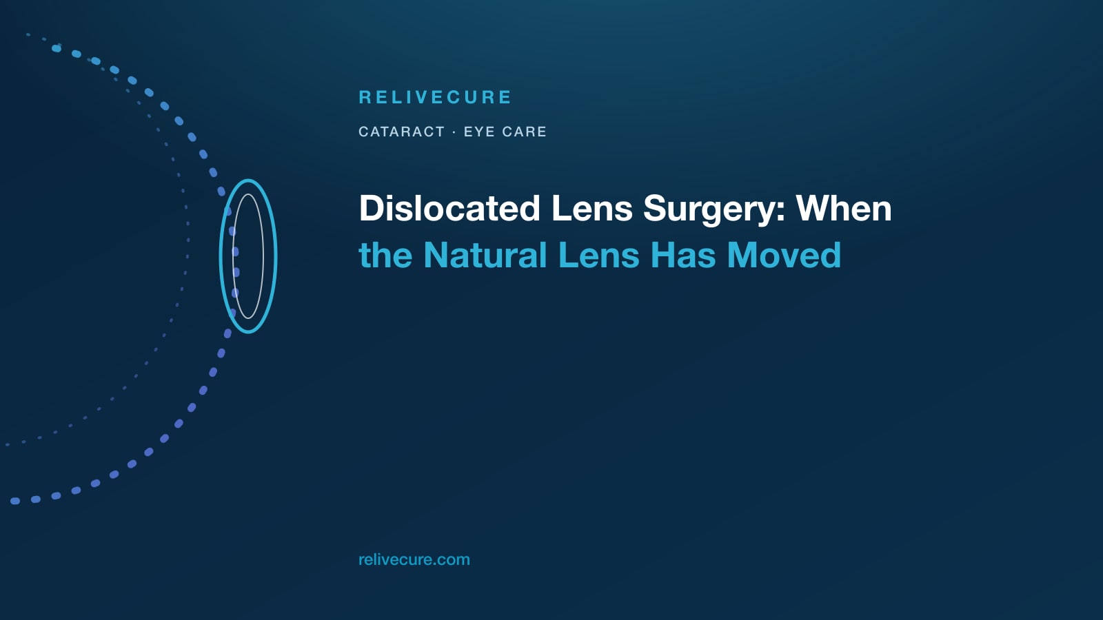 ReliveCure navy-and-cyan editorial still: Dislocated Lens Surgery: When the Natural Lens Has Moved